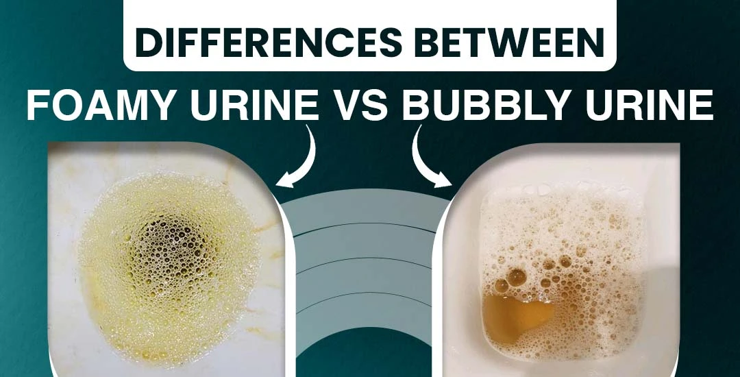 What is the Difference Between Bubbles and Foam in Urine?